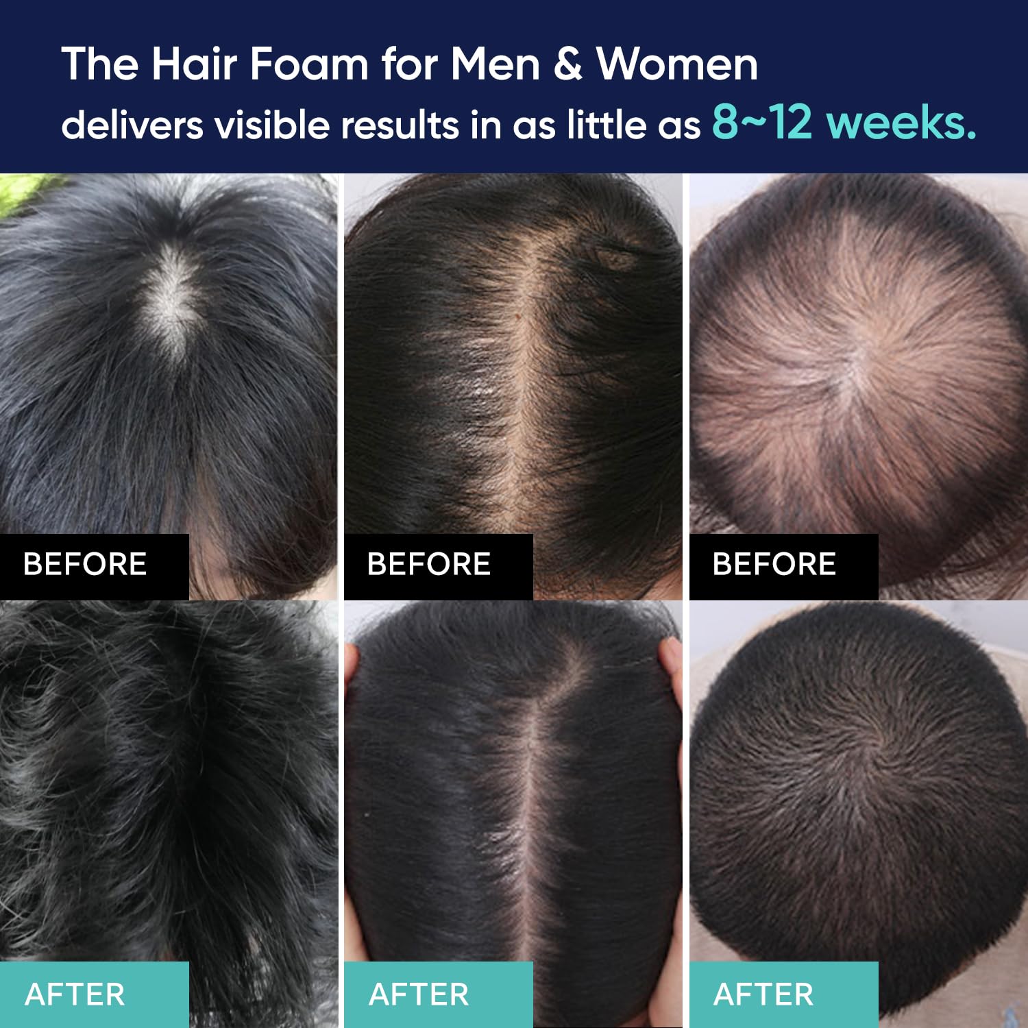 Kirkland Minoxidil & Derma Roller